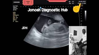 FETAL GENDER DETERMINATION ON ULTRASOUND  ITS A BABY BOY 🍼 jonoshMedicalHub [upl. by Iur194]