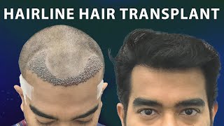 Natural Looking Hairline Transplant at Hairfree Hairgrow Clinic Kolkata using Sapphire FUE Method [upl. by Erl]