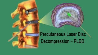 PLDD  Percutaneous Laser Disc Decompression [upl. by Creigh410]