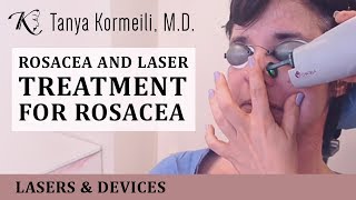 Rosacea and laser treatment for rosacea [upl. by Chitkara]