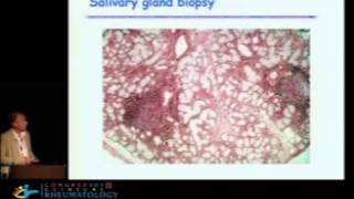 Update on Sjogrens syndrome from pathogeny to treatment  Xavier Mariette MD PhD [upl. by Sivaj]