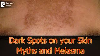 Dark Spots on your Skin  Hormones Vitamin D Melasma  Dr Aruna Prasad [upl. by Erwin]