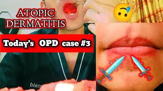 Atopic Dermatitis ❤️General OPD CASE 3 ❤️ skincare skincareroutine treatment girl eczema [upl. by Ejroj473]