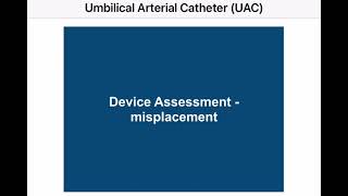 Umbilical artery catheter [upl. by Einrae]