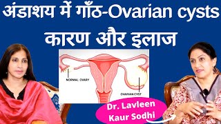 Ovarian Cysts। ओवरी में सिस्ट क्यों हो जाती हैं क्या है इलाज। Dr Lavleen Sodhi [upl. by Nerw945]