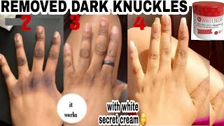 How to get rid of DARK KNUCKLES fastRemedies amp products for Soft amp Even hands ✨ [upl. by Boy]