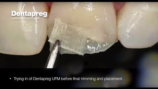 Restoration of Chipped Incisal Edge by Dr Dennis Hartlieb [upl. by Nnylylloh]