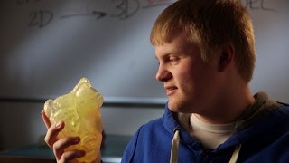 3D Printed HeartPrint® Model Helps 16 Year Old Heart Tumor Patient [upl. by Madella]