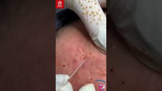 CloseUp Pimple Popping Tips to Eliminate Blackheads and Whiteheads  Part 11 Pimples Blackheads [upl. by Pirali]