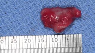 Marsupialization  Decompression of Odontogenic Cysts Part 2 [upl. by Elnore]