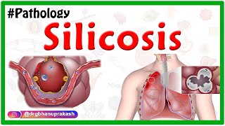 Silicosis Miners phthisis Grinders asthma  Etiology  Pathophysiology  Diagnosis Treatment [upl. by Aiksas370]