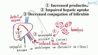 unconjugated hyperbilirubinemia [upl. by Mcguire444]