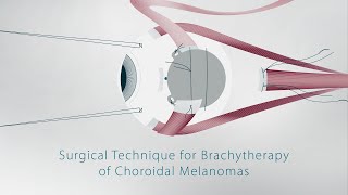 Surgical Technique for Brachytherapy of Choroidal Melanomas [upl. by Jessika]