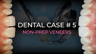 NONPREP VENEERS  DENTAL CASE 5 [upl. by Mitch]