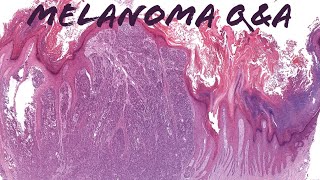 Melanoma Pathology QampA Discussion Immunostains Excision Specimens Nodal Nevus amp More [upl. by Soble]