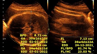 About 35 weeks 2 days 15days of single viable pregnancy  Sonographic prediction [upl. by Nickie]