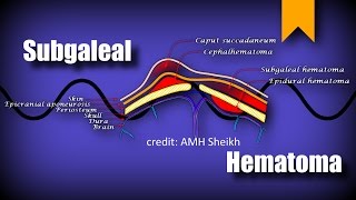 Subgaleal Hematoma [upl. by Akenet]