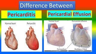 Difference between Pericarditis and Pericardial Effusion [upl. by Aisan112]