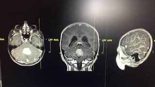 Beyin tümörü tomografi mr görüntüsü [upl. by Ayotal]