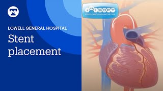 Stent Placement [upl. by Lennej708]