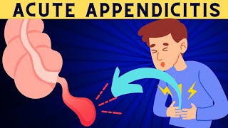 Acute Appendicitis Signs And Symptoms Risk Factors Diagnosis And Treatment [upl. by Gianni]