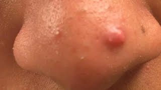 how to get rid of nose acne bumps tutorial [upl. by Meade]