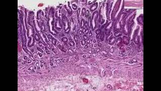 Histopathology StomachAtrophic gastritis [upl. by Danie656]