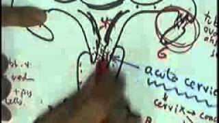 GENITAL 1 gonorrhea cervicitis endometrium DR SAMEH GHAZY [upl. by Soisinoid]