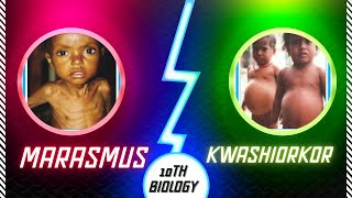 Marasmus and kwashiorkor nutritional deficiency diseases detailed explanation with pictures [upl. by Herrera27]