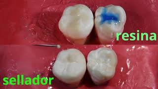 como se hacen una resina dental y sellador de fosetas y fisuras 2 X 1 [upl. by Lenssen]