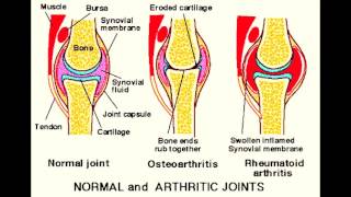 Osteoarthritis vs Rheumatoid Arthritis Joints Overview [upl. by Eet40]