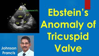 Ebsteins Anomaly of Tricuspid Valve [upl. by Aneelehs]