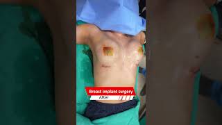 Breast implant surgery  Breast implant surgery cost short SHort shorts [upl. by Deryl]