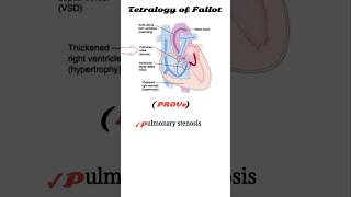 tetralogy of fallot mnemonic  TOF [upl. by Risan248]