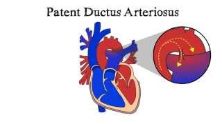 Patent Ductus Arteriosus PDA [upl. by Salena]