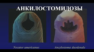 Анкилостомидозы Анкилостомоз Ancylostoma duodenale и Некатороз Necator americanus [upl. by Ursas]