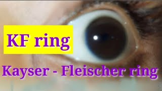 Kayser  Fleischer ring  Wilsons disease [upl. by Croft]