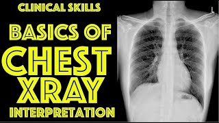 How To Read A Chest Xray For Beginners  Dr Gill [upl. by Notnirb]