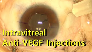 Intravitreal injection technique 유리체강내 아바스틴 주사술 [upl. by Sebastiano410]