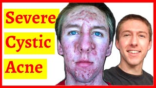 Cystic Acne Skin Clearing Transformation  10 Month Timelapse [upl. by Cychosz]