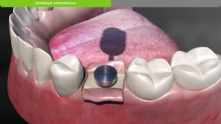 Biotech Dental Protocole chirurgical de pose dun implant dentaire KONTACT souscrestal [upl. by Yessak]