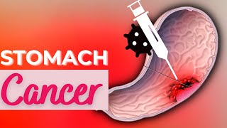 Stomach Cancer Causes Signs and Symptoms Diagnosis and Treatment [upl. by Lashar]