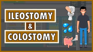 Ileostomy and Colostomy  Emphasis on DietNutrition [upl. by Naivatco217]