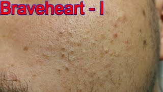 Extraction for Teenage Acne  Part 1 of 3 [upl. by Verlee146]