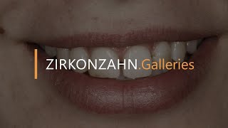 Prettau® veneers with PlaneSystem® and Face Hunter  ZirkonzahnGalleries [upl. by Brotherson]