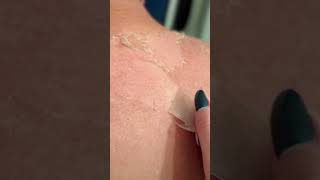 Skin peel after sunburn [upl. by Trbor812]