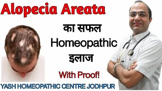 Alopecia Areata treatment  hair loss treatment  baldness best treatment बाल झड़ने का तेल ईलाज [upl. by Allemrac268]