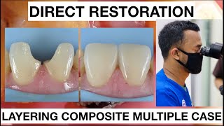 Step by step Layering Anterior Multiple Case Composite  General Dentist Griya RR [upl. by Eikcor473]