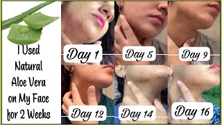 2 Weeks Aloe Vera Challenge Real Results Will it clear acne amp fade scars [upl. by Boak]