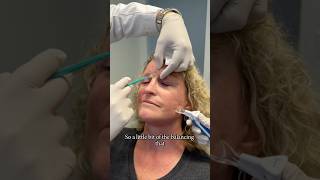 25 months postop selective neurolysis surgery Botox explanation bellspalsy botox facialpalsy [upl. by Ecire]